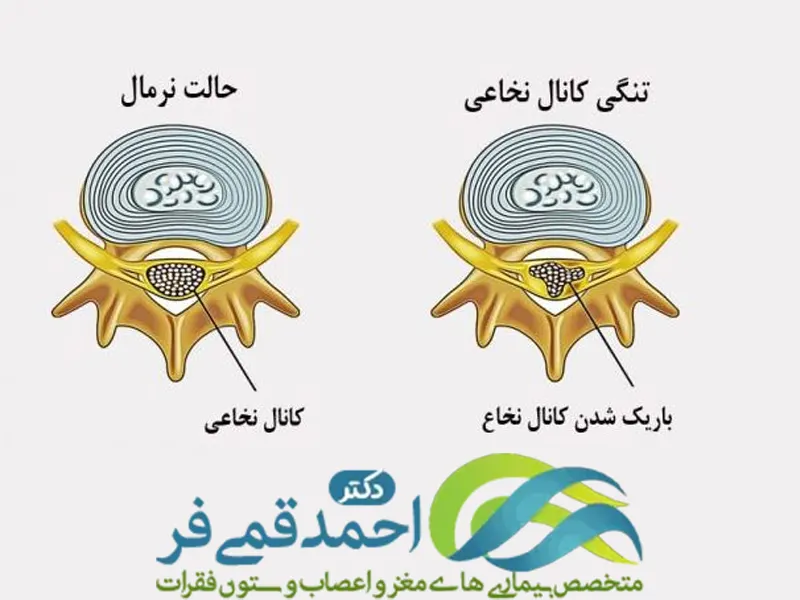 تشخیص تنگی کانال نخاعی